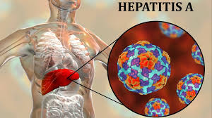 Resultado de imagen para hepatitis a